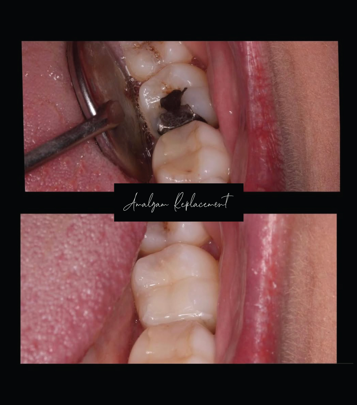 Amalgam Replacement