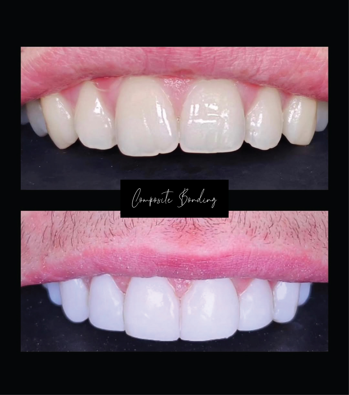 Composite Bonding