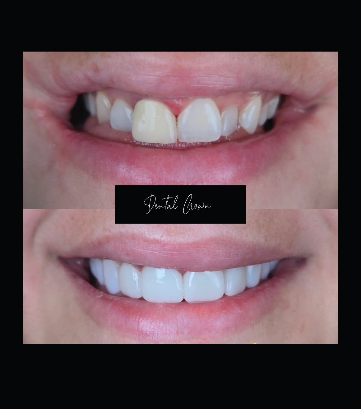 Dental Crown