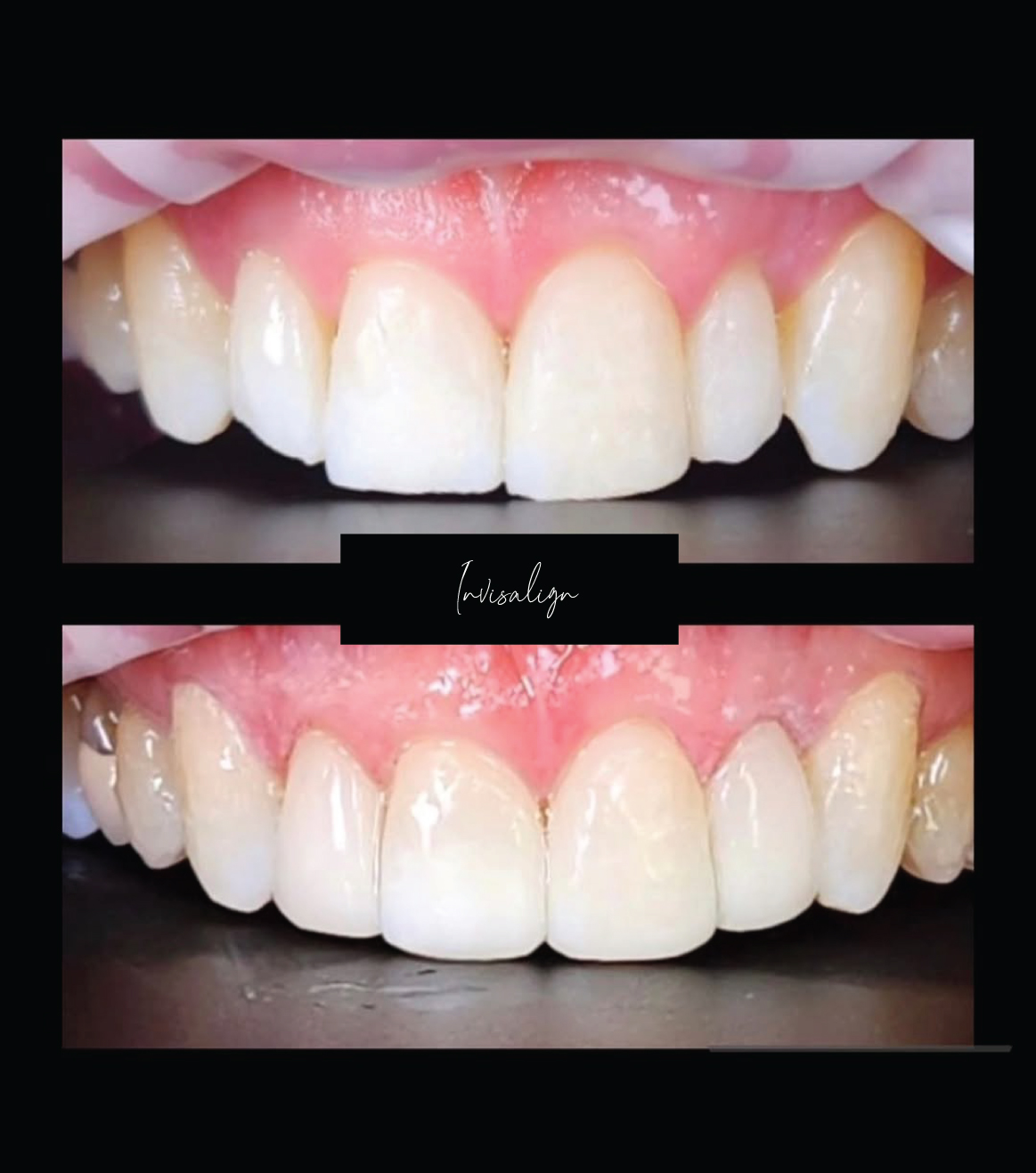 Invisalign
