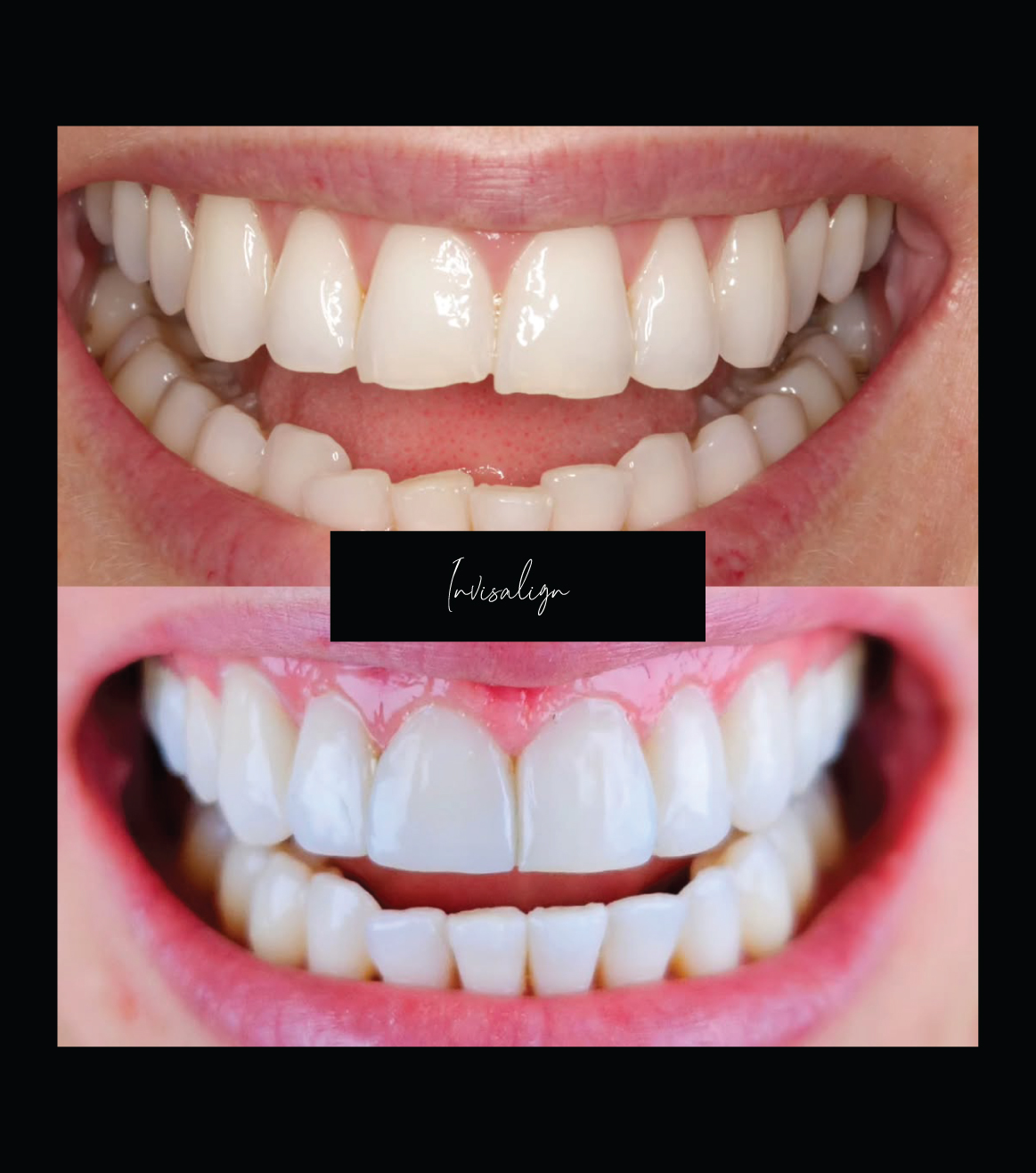 Invisalign