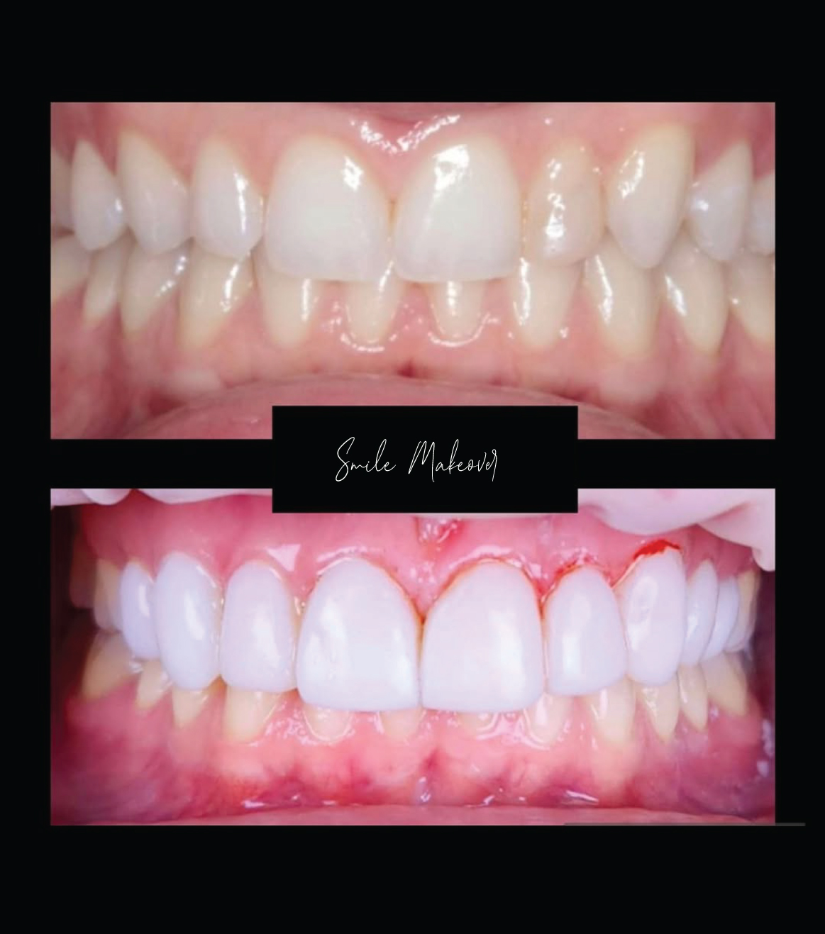 Smile Makeover