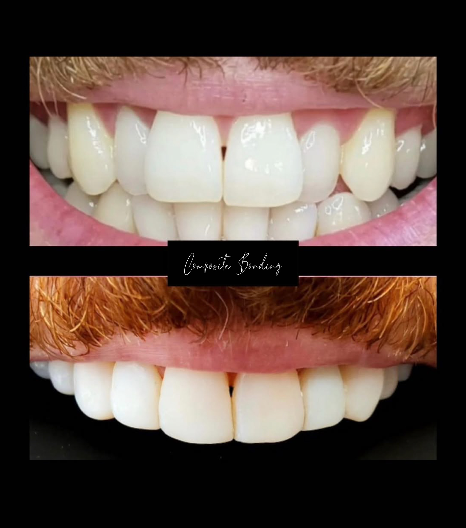 Composite Bonding