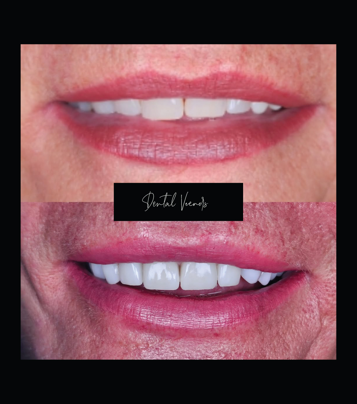 Dental Veneers