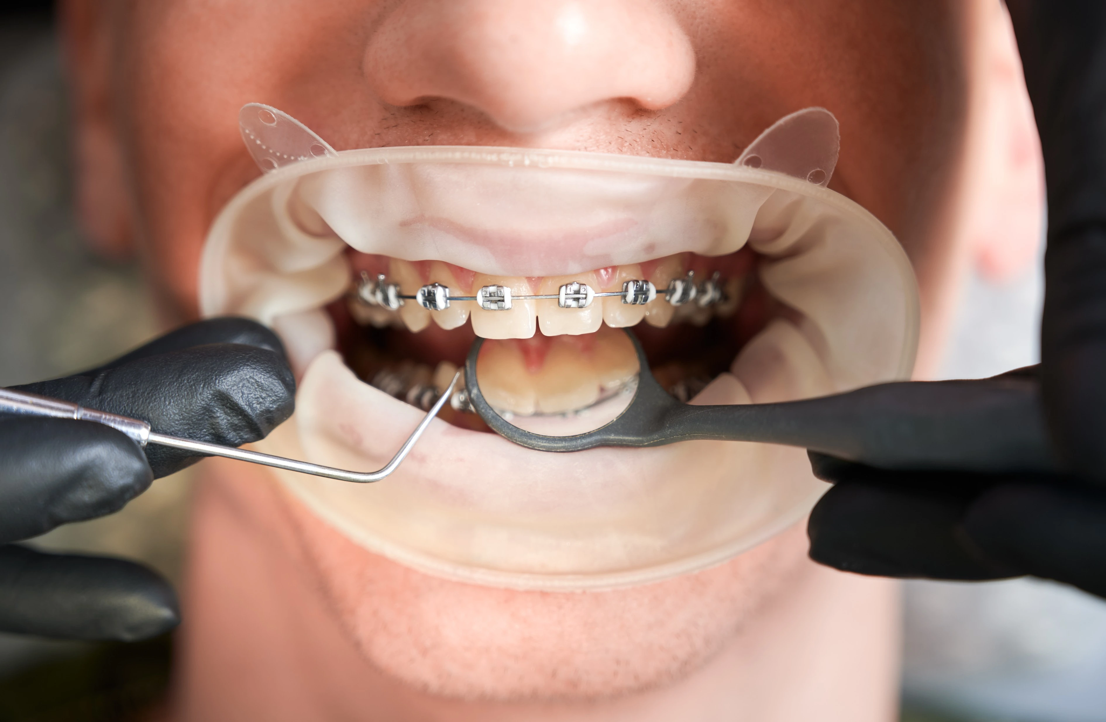 Orthodontic Treatment