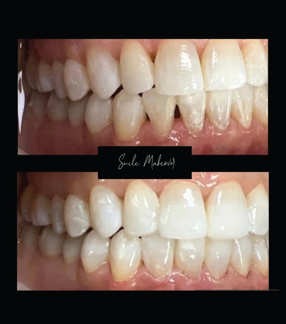Smile Makeover